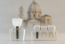 Immagine ravvicinata e dettagliata di modelli concettuali di un impianto dentale e un ponte dentale, posizionati su uno sfondo pulito e moderno. Sullo sfondo sfocato si intravede un elemento architettonico italiano. L'illuminazione è cinematografica e la profondità di campo è bassa.