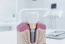 Un primo piano fotorealistico di un impianto dentale perfettamente integrato con vite in titanio e corona in ceramica, simbolo di longevità e salute orale.