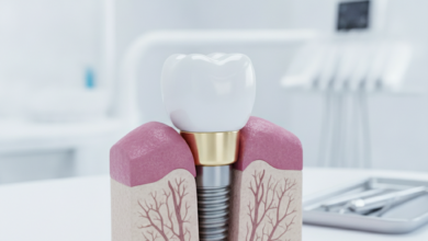 Un primo piano fotorealistico di un impianto dentale perfettamente integrato con vite in titanio e corona in ceramica, simbolo di longevità e salute orale.