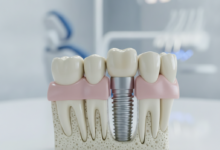 Modello anatomico di un impianto dentale inserito nella mandibola, con dettagli chiari della vite in titanio e della struttura ossea, su uno sfondo sfocato di attrezzature dentistiche e un ambiente clinico pulito. L'immagine è ad alta risoluzione, senza testo visibile.