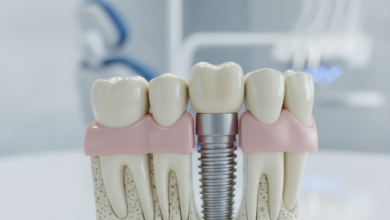 Modello anatomico di un impianto dentale inserito nella mandibola, con dettagli chiari della vite in titanio e della struttura ossea, su uno sfondo sfocato di attrezzature dentistiche e un ambiente clinico pulito. L'immagine è ad alta risoluzione, senza testo visibile.