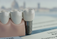 Immagine ravvicinata e dettagliata di un impianto dentale moderno con corona in ceramica, inserito in una gengiva sana. Lo sfondo è sfocato e suggerisce documenti finanziari e un paesaggio urbano italiano lontano, senza testo visibile.